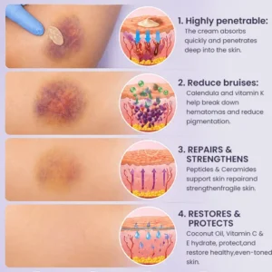 OFFICIAL
          BRAND
        

        𝑴𝑹𝑬𝑽𝑩𝑺𝑰𝑵®
      

      
        Bruise Recovery Cream · Advanced Purple Care Formula for Bruises, Bumps & Visible Discoloration