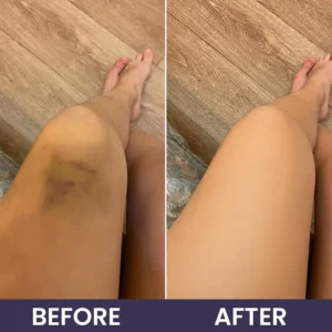 OFFICIAL
          BRAND
        

        𝑴𝑹𝑬𝑽𝑩𝑺𝑰𝑵®
      

      
        Bruise Recovery Cream · Advanced Purple Care Formula for Bruises, Bumps & Visible Discoloration